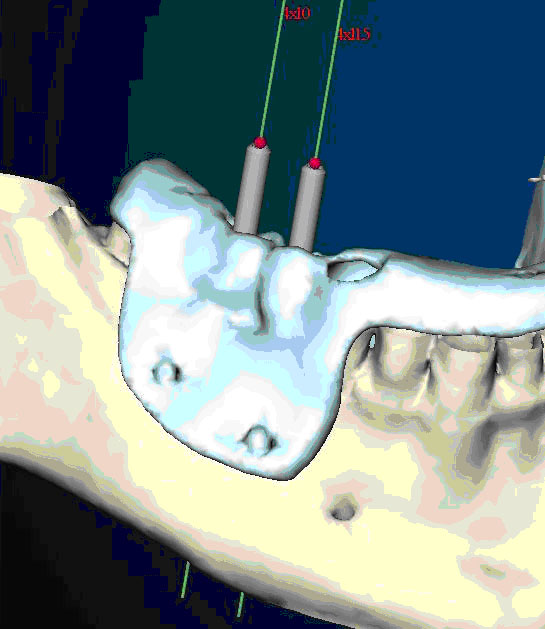 Gli impianti in endodonzia fig 1