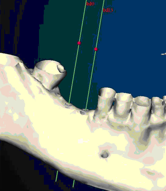 Gli impianti in endodonzia fig 2