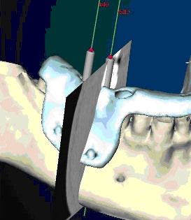 Gli impianti in endodonzia fig 3