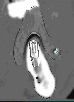 Gli impianti in endodonzia fig 4