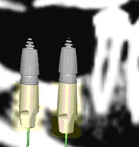 Gli impianti in endodonzia fig 6