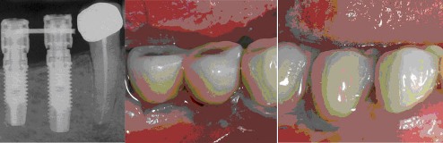 Gli impianti in endodonzia fig 9