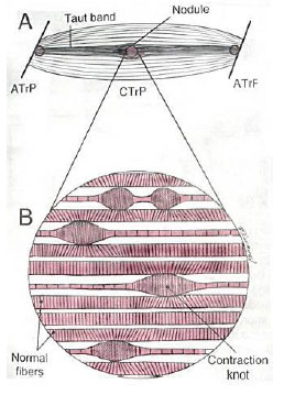 Cefalee tensive e disordini cranio-mandibolari fig 2