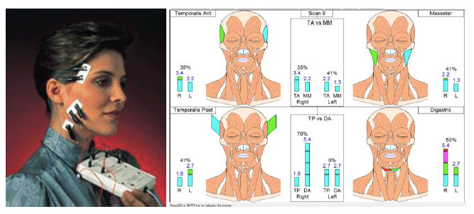 Cefalee tensive e disordini cranio-mandibolari fig 5