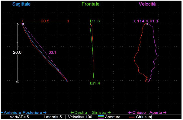 Interferenze dentali in paziente con disordine cranio-mandibolare fig 3