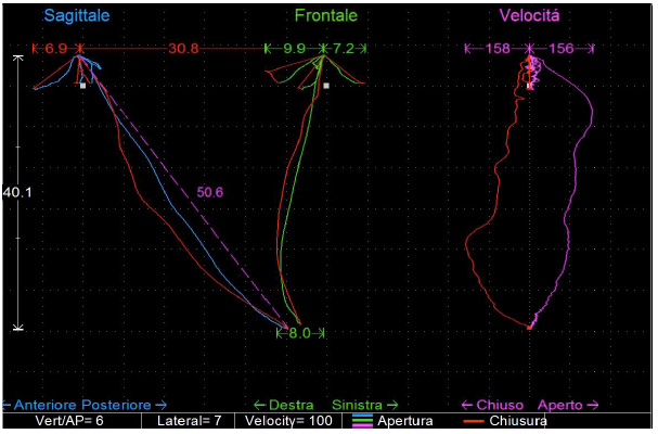 Interferenze dentali in paziente con disordine cranio-mandibolare fig 4
