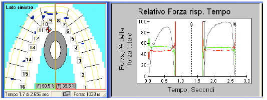 Interferenze dentali in paziente con disordine cranio-mandibolare fig 5