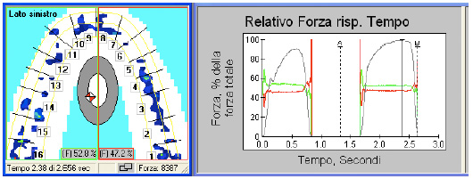 Interferenze dentali in paziente con disordine cranio-mandibolare fig 6