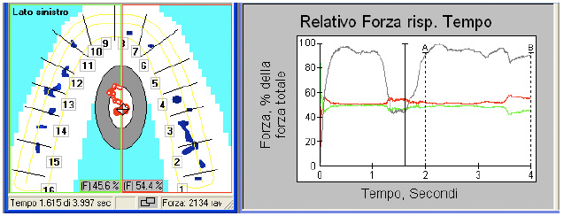 Interferenze dentali in paziente con disordine cranio-mandibolare fig 7