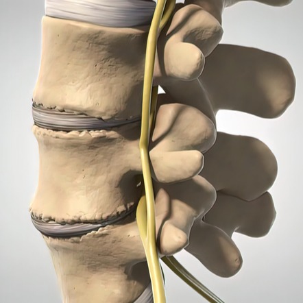 Illustrazione grafica per Spondilolistesi