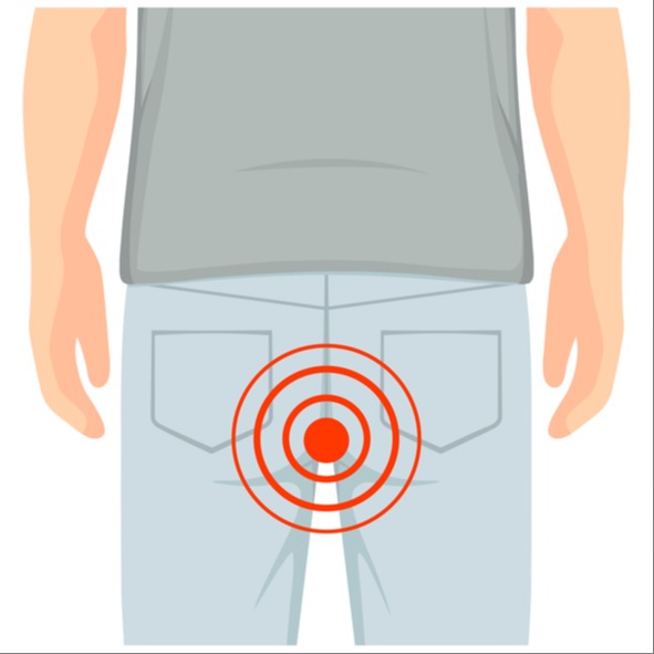 Illustrazione grafica per Fistole anali