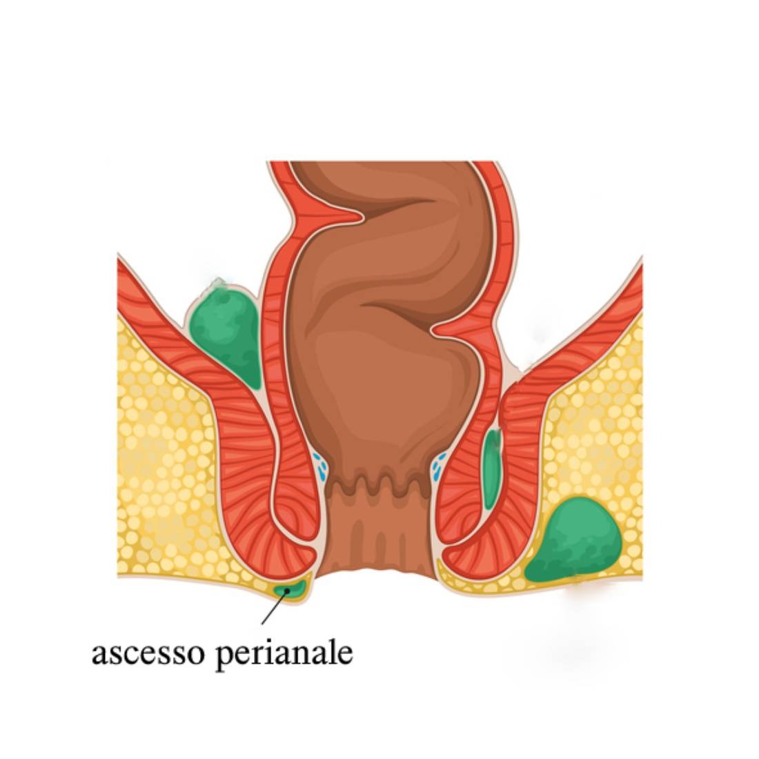 Illustrazione grafica per Ascesso perianale