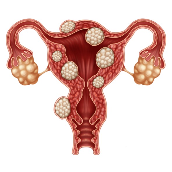 Illustrazione grafica per Fibromatosi uterina