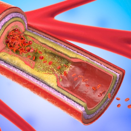 Illustrazione grafica per Stenosi carotidea