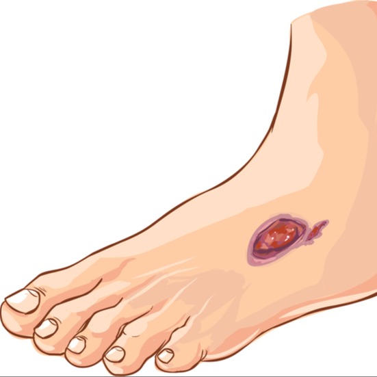 Illustrazione grafica per Neuropatia diabetica