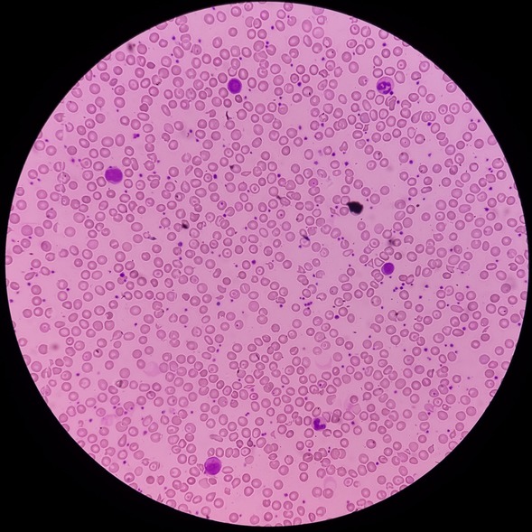 Illustrazione grafica per Sferocitosi (ittero emolitico di Minkowski e Chauffard)