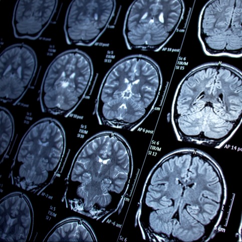 Illustrazione grafica per Epilessia