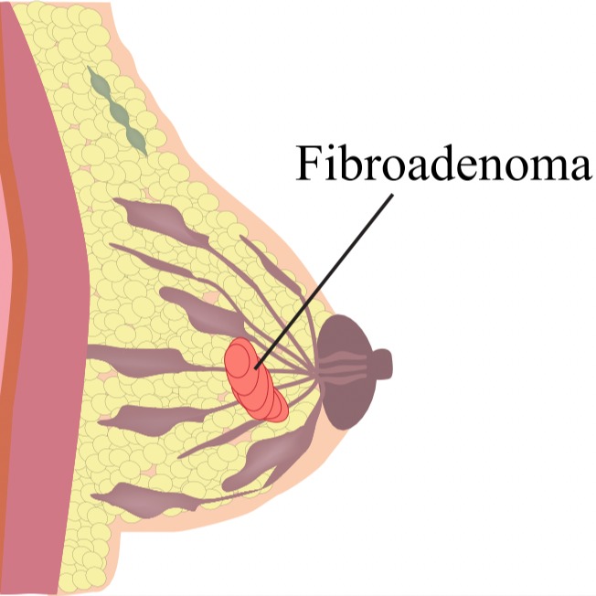 Illustrazione grafica per Fibroadenoma