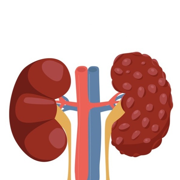 Illustrazione grafica per Cisti renali