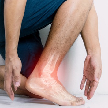 Artrosi della caviglia