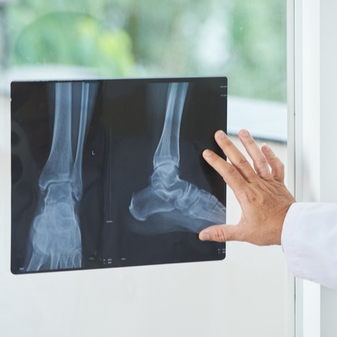 Artrosi della caviglia