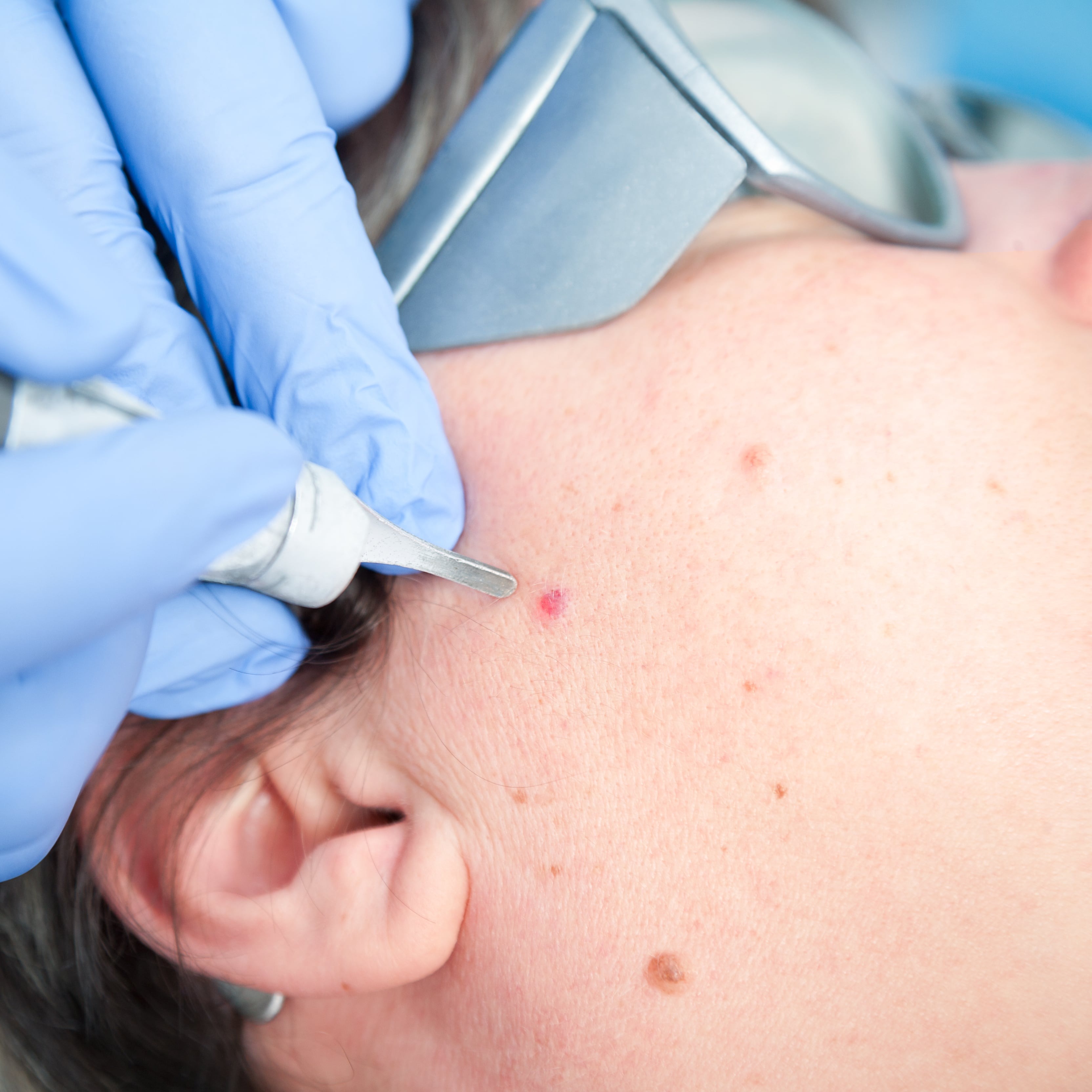 Illustrazione grafica per Macchie della pelle