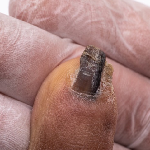 Onicogrifosi (unghia ad artiglio)