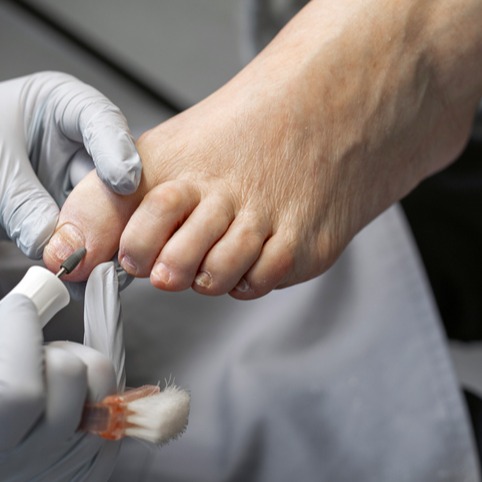 Onicogrifosi (unghia ad artiglio)