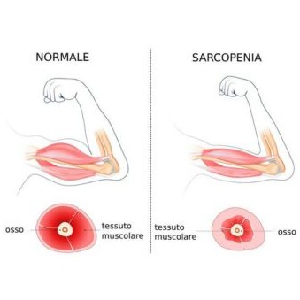Sarcopenia