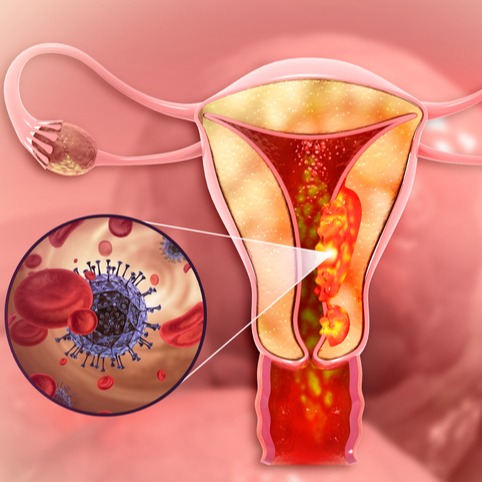 Tumore dell'endometrio