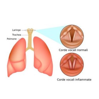 Croup (laringotracheobronchite)