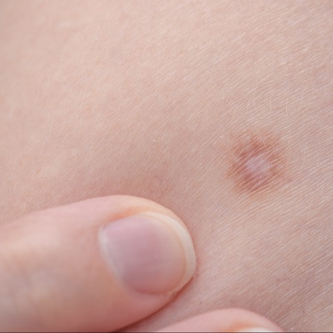 Illustrazione grafica per Dermatofibroma