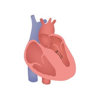Illustrazione grafica per Ipertrofia ventricolare