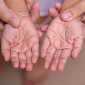 Illustrazione grafica per Malattia mani-piedi-bocca