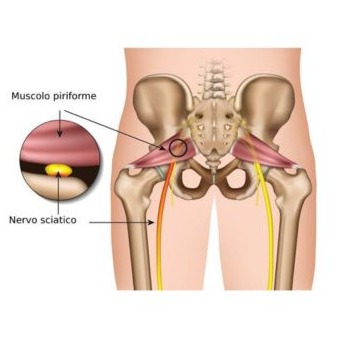 Sindrome del piriforme