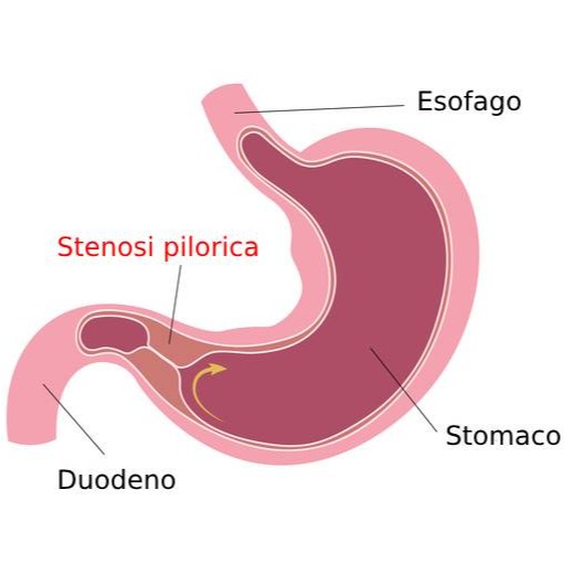 Stenosi pilorica